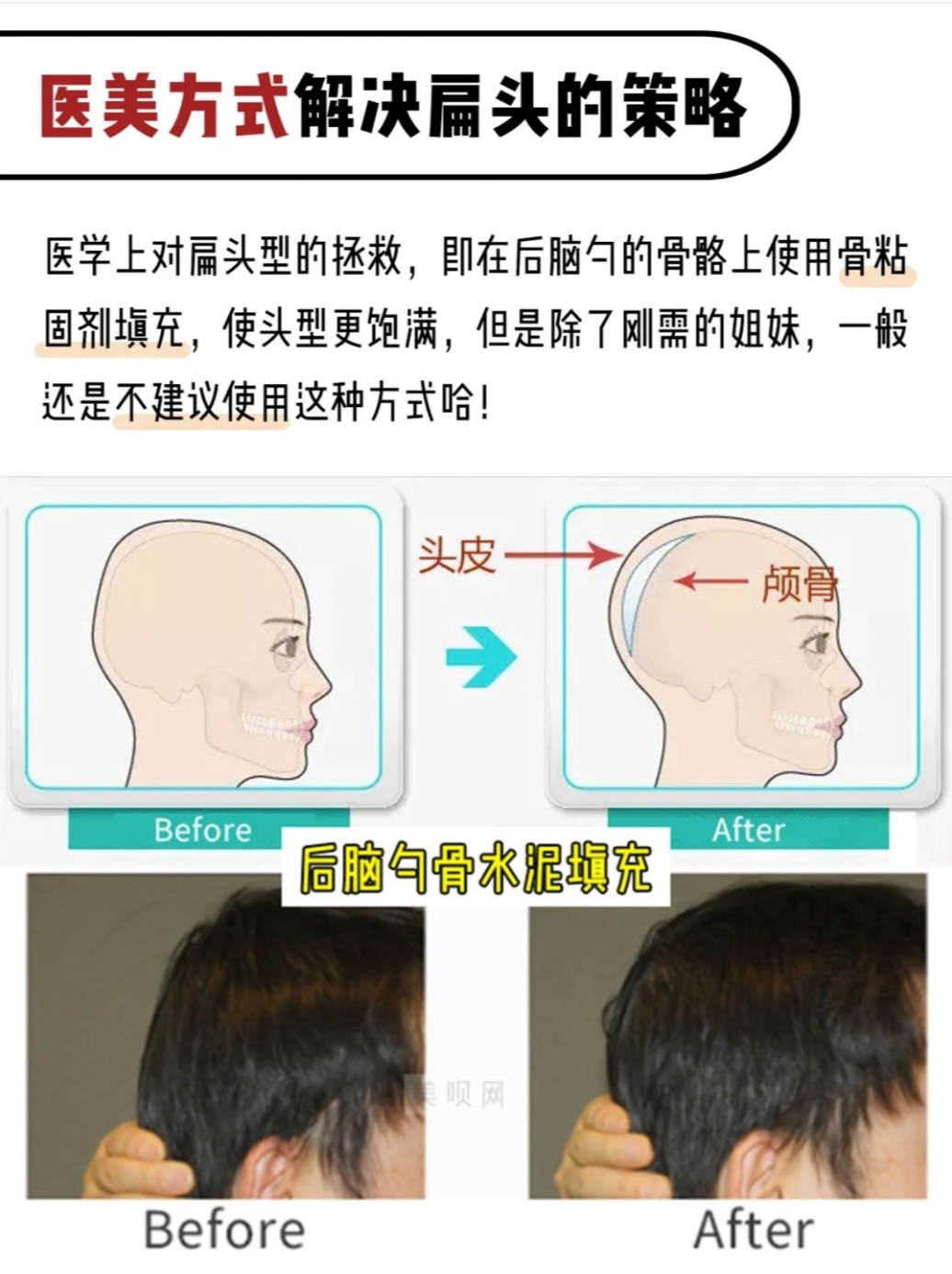 扁头自救指南!郎朗老_圈子-新氧美容整形