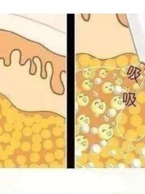 通过皮肤小切口或穿刺孔,将预处理或未经处理的皮下脂肪去除,并结合
