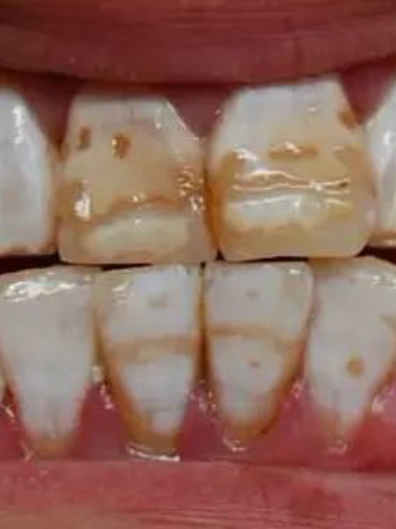 氟斑牙是一种特殊的,原因明确的釉质发育不全,与通常_圈子-新氧美容