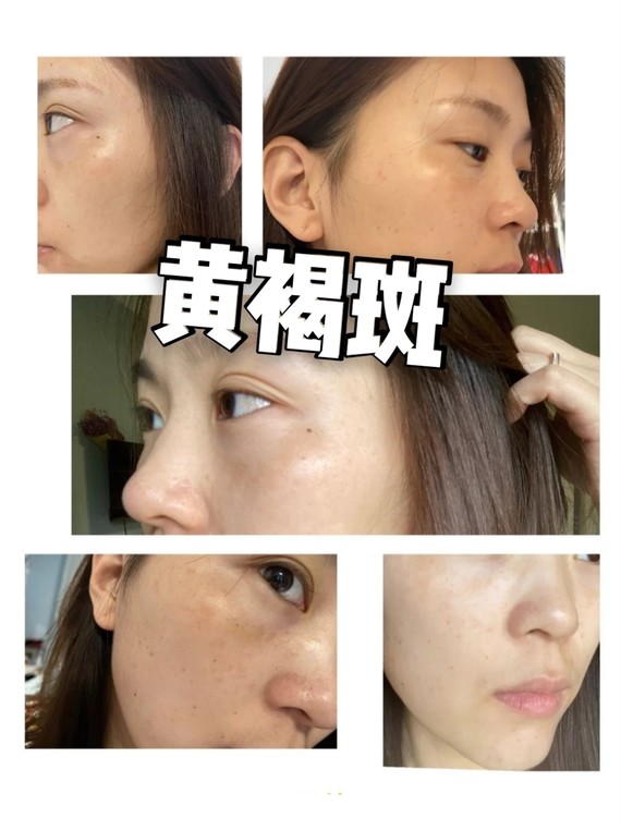 979797激光祛斑后会反弹吗71反黑是失败了吗?