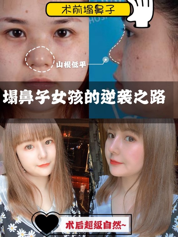 塌鼻子女孩的逆袭之路