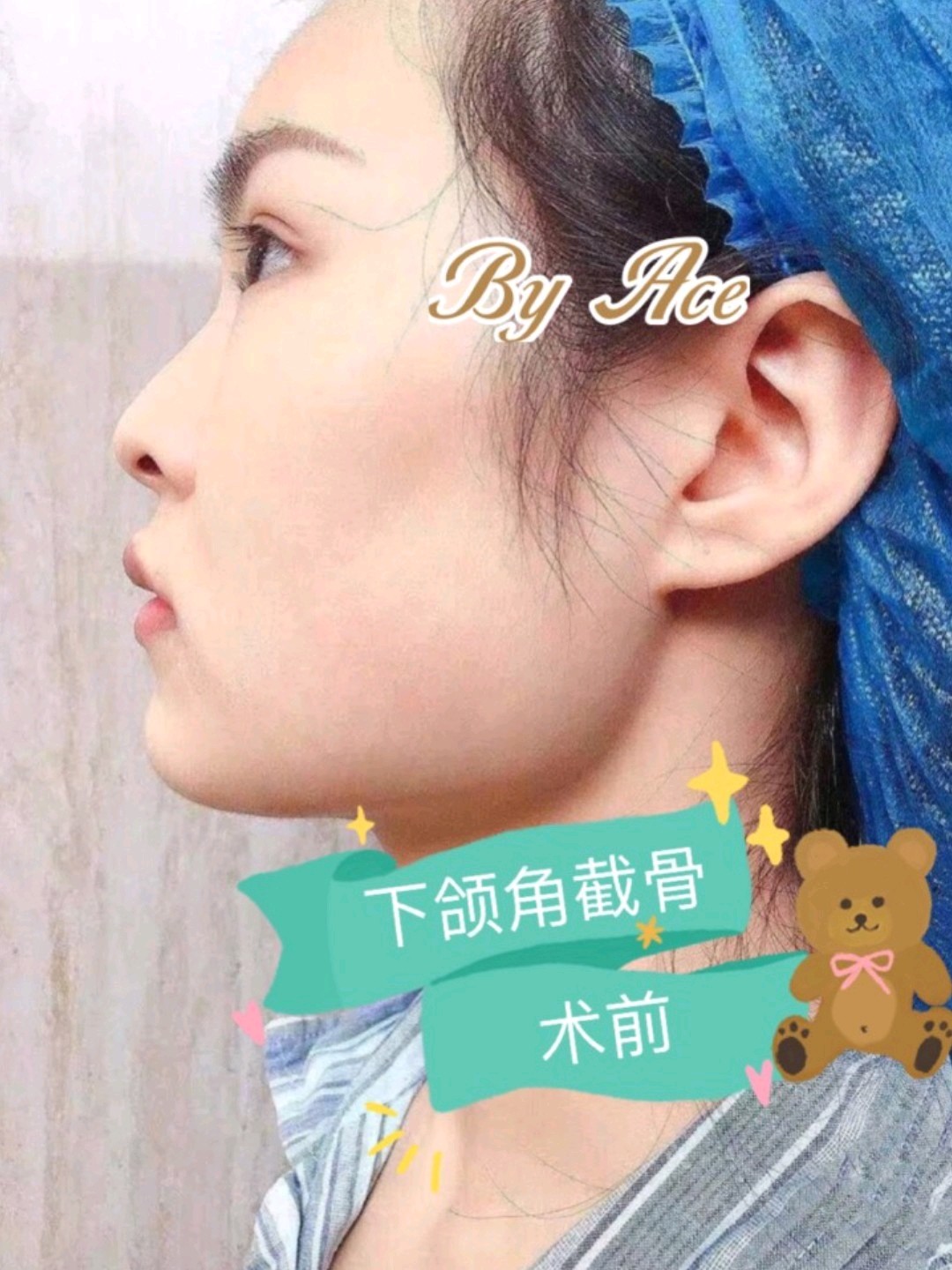 但是下颌角如果存在类似的内扣肥厚情况 只单纯切除下颌角,术后从