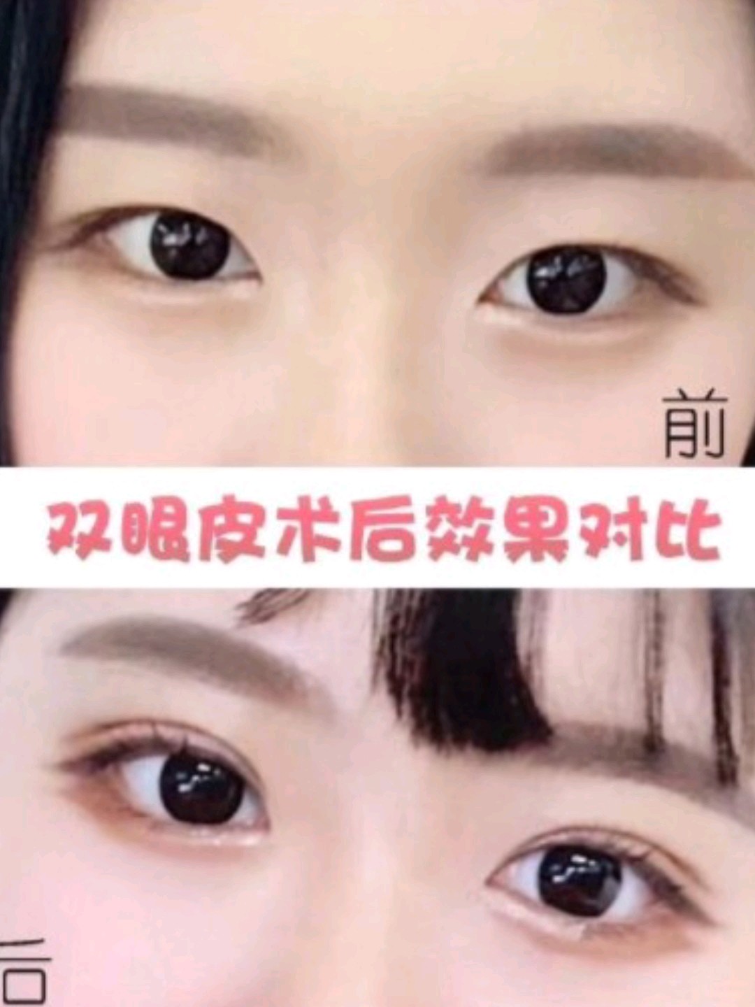 双眼眼皮出现褶皱呈内双,眼皮松弛下垂,存在提肌无力的现象,内眼角有