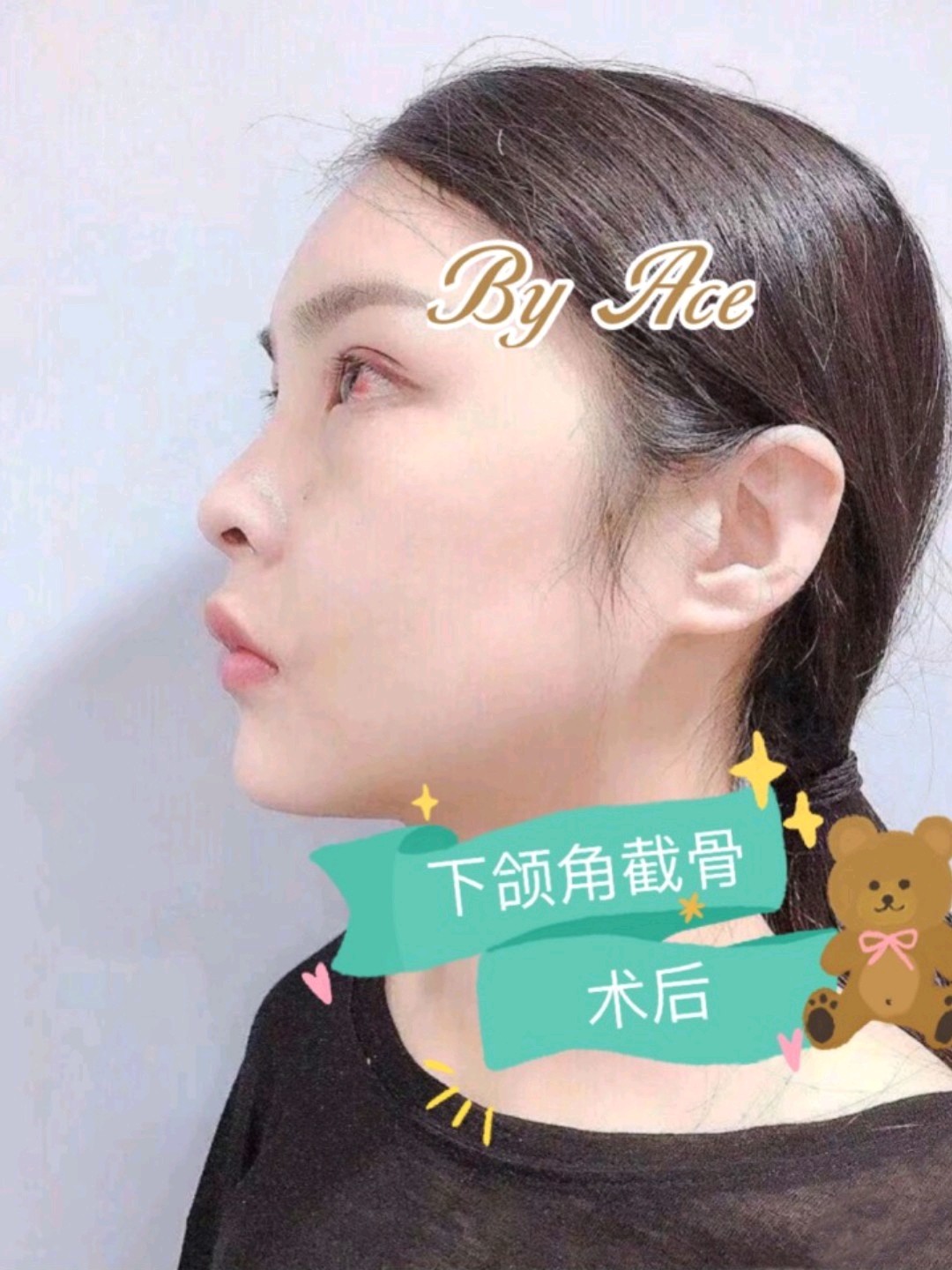 但是下颌角如果存在类似的内扣肥厚情况 只单纯切除下颌角,术后从