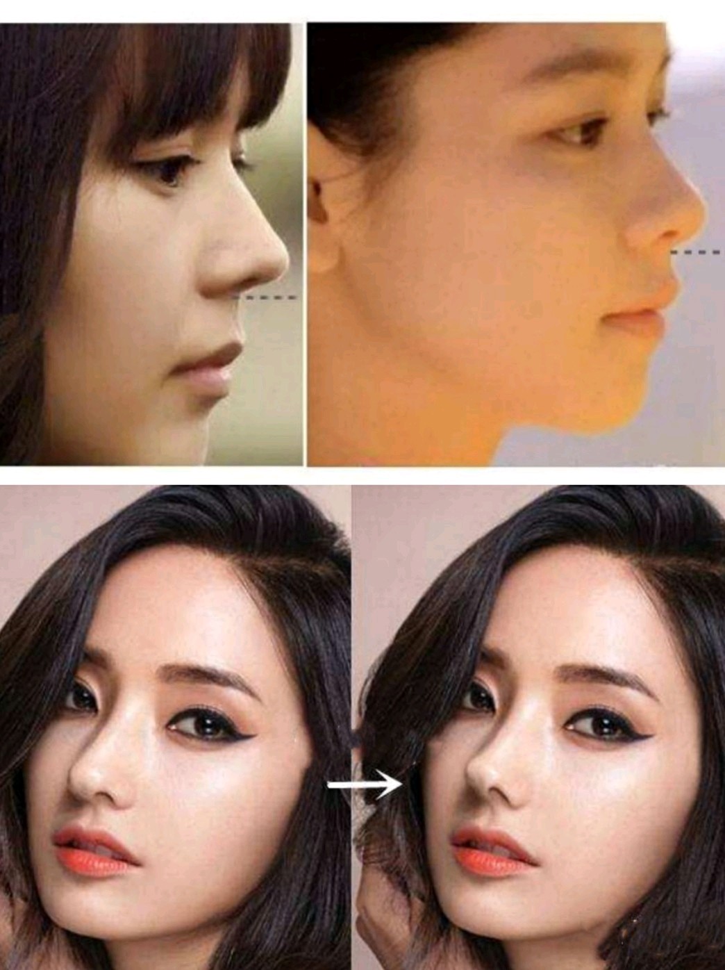 7215韩式小翘鼻一直都是鼻整形中格外被偏爱的鼻