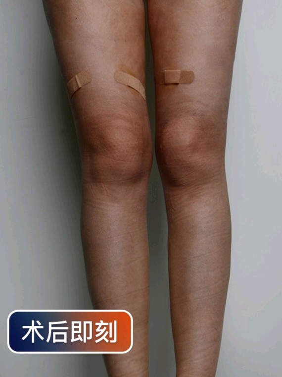 大腿中段和腿根衔接不流畅,腿部多处凹坑,臀大腿细不协调