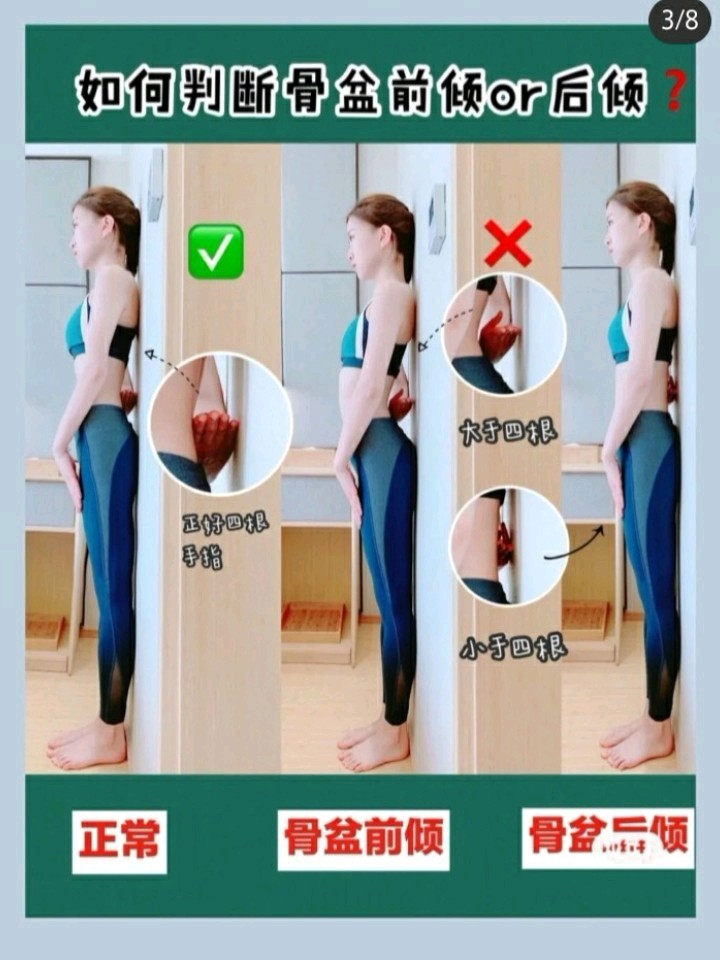 骨盆前倾从侧面看屁股很翘,但整个人都是歪的!