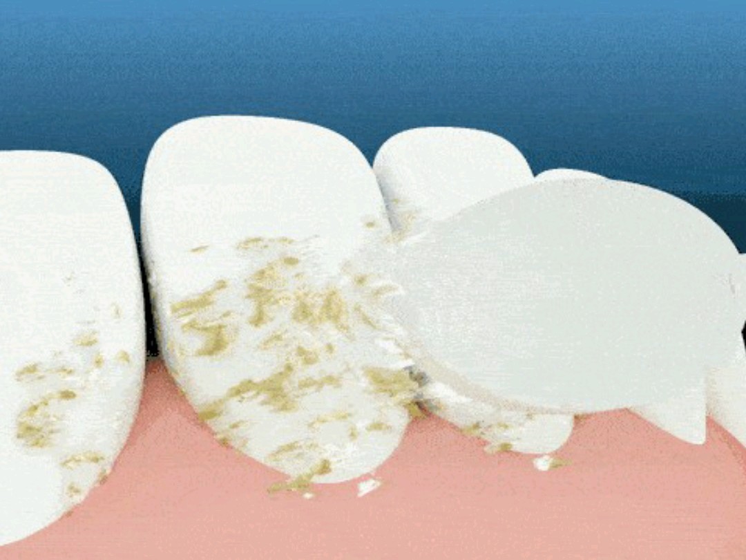 一,牙菌斑和牙结石