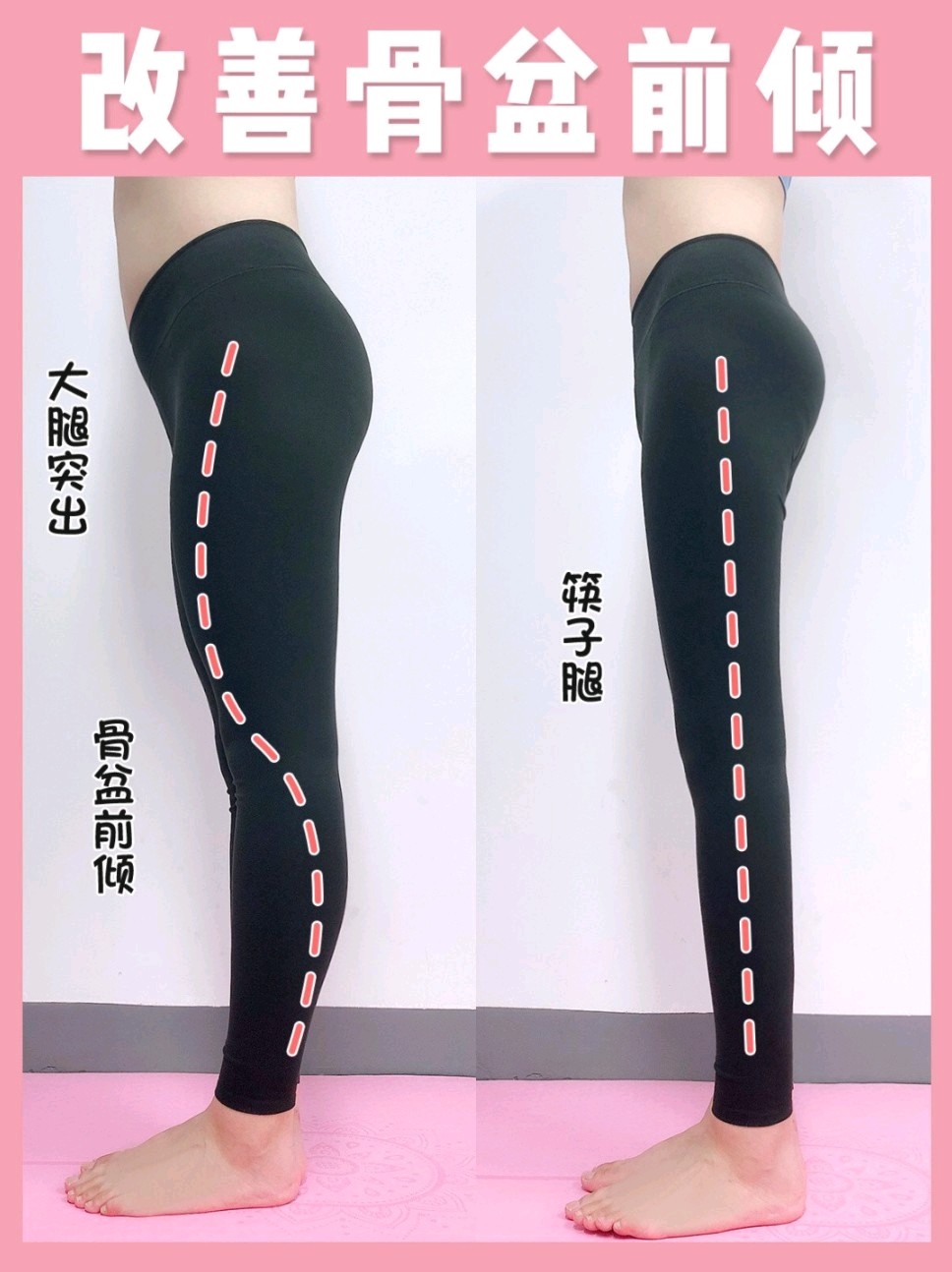 骨盆前倾