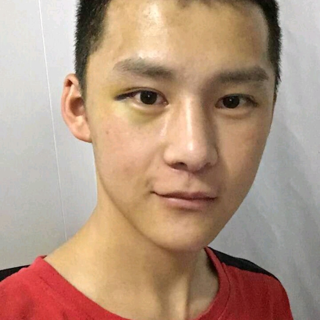 【假体丰下巴】【膨体垫下巴】男士man下巴,更显刚硬轮廓线条