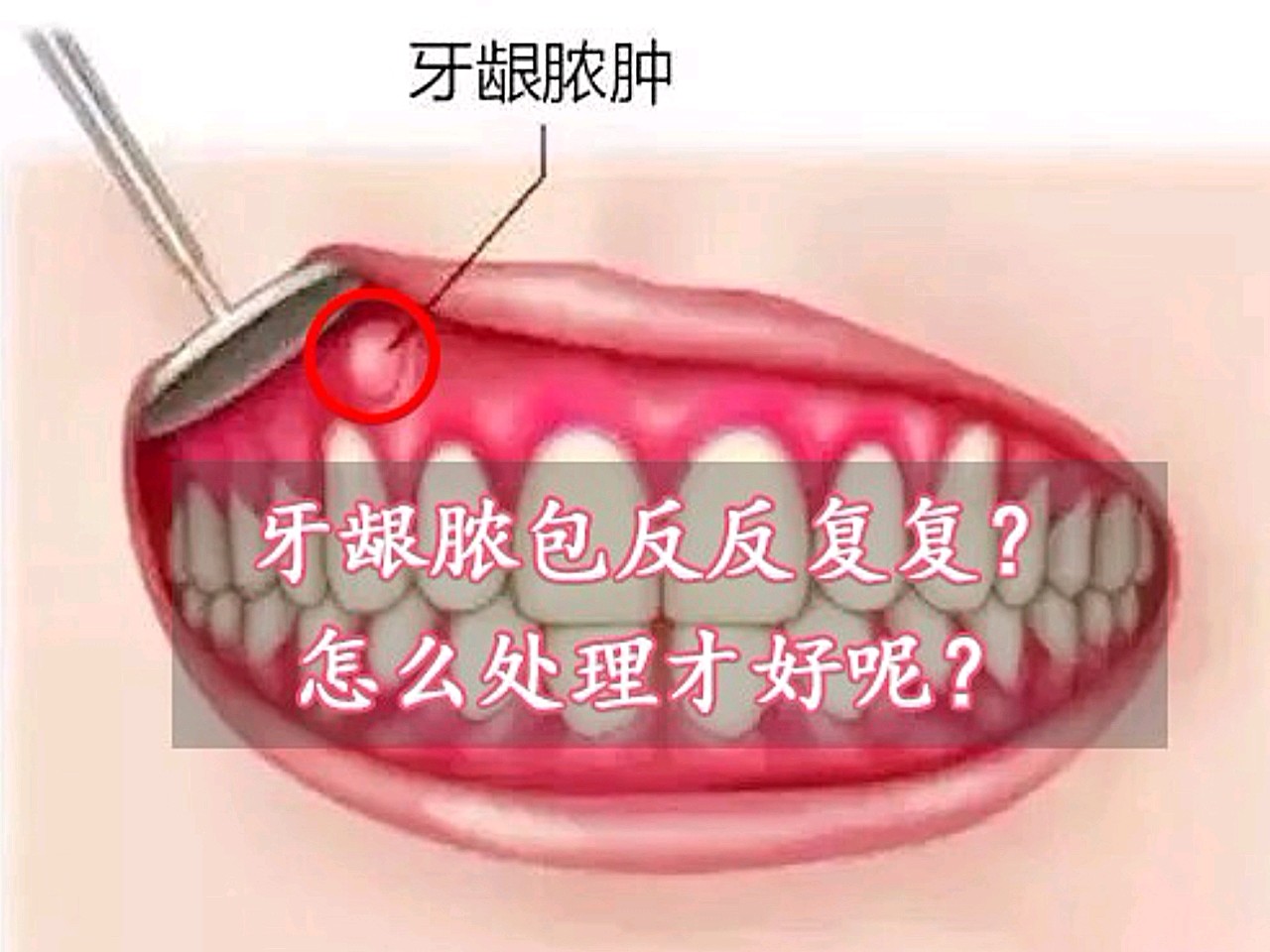 牙肉重建案例分享 - Dr. Implant 新竹光明牙醫診所