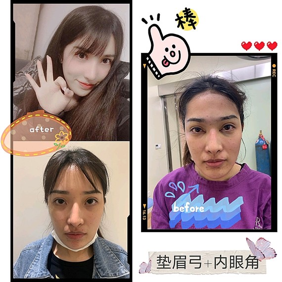 【假体垫眉弓】