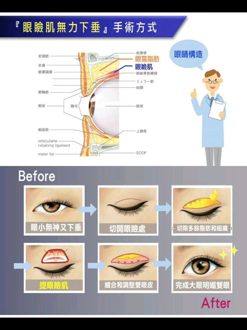 美眼女神都做了上眼睑提肌哟!
