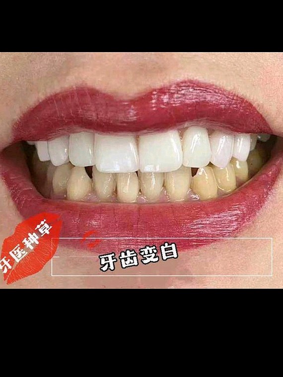 亲测有效,牙医吐血分享牙齿美白7515牙医支招,美