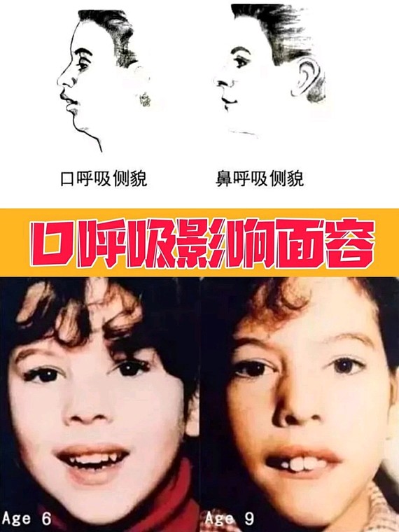 比如说长期口呼吸等等,导致上唇短厚翘起,下颌后缩,牙齿拥挤,上切牙