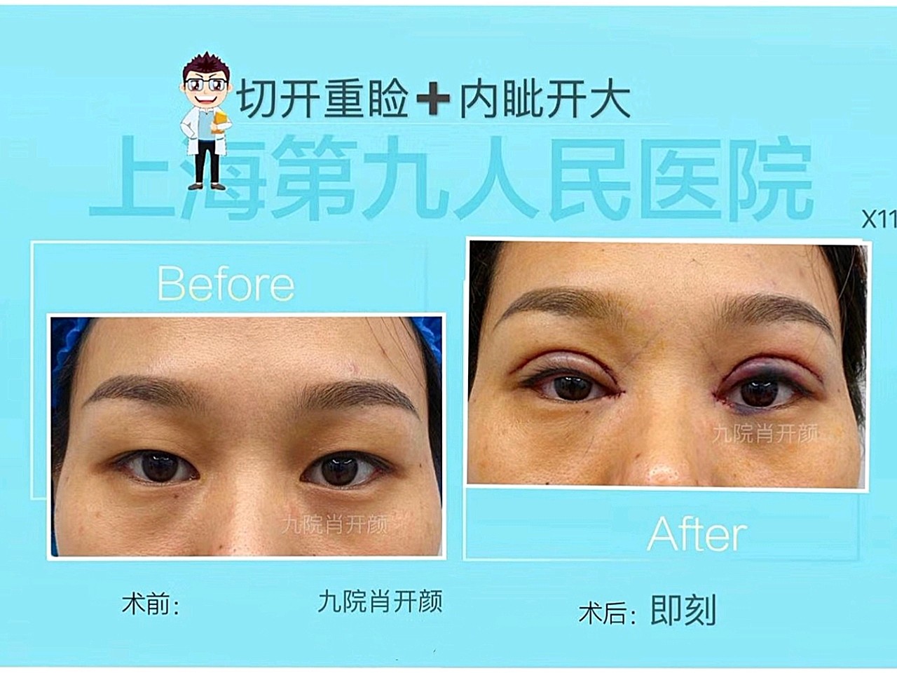 切开重睑 内眦开大|术后即刻