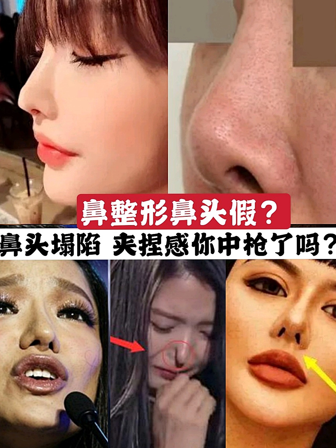 鼻整形鼻头假,鼻头塌陷,夹捏感你中枪了吗?