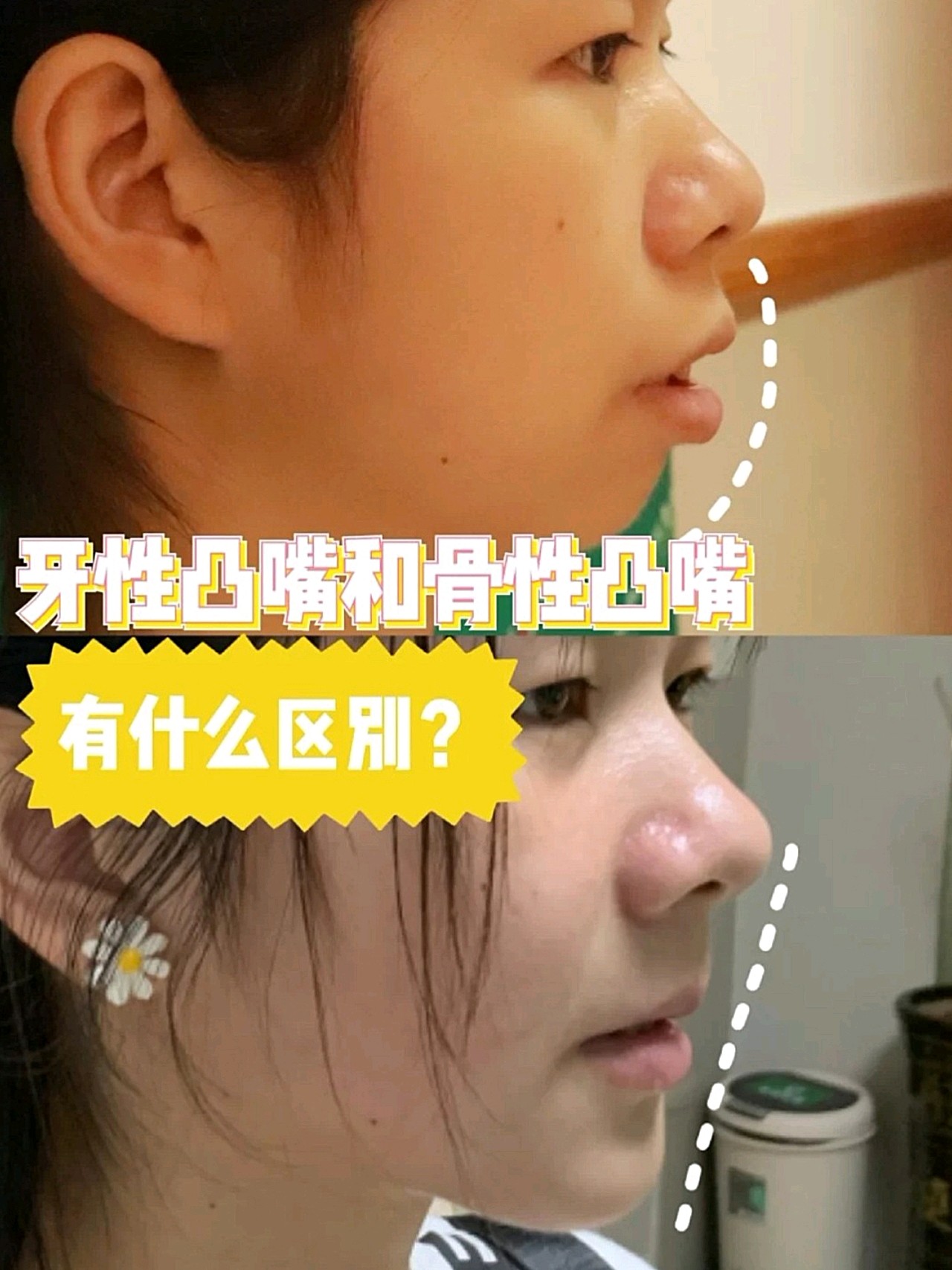 但是很多人都分不清自己应该去做牙齿正畸还是颌面矫正手术.