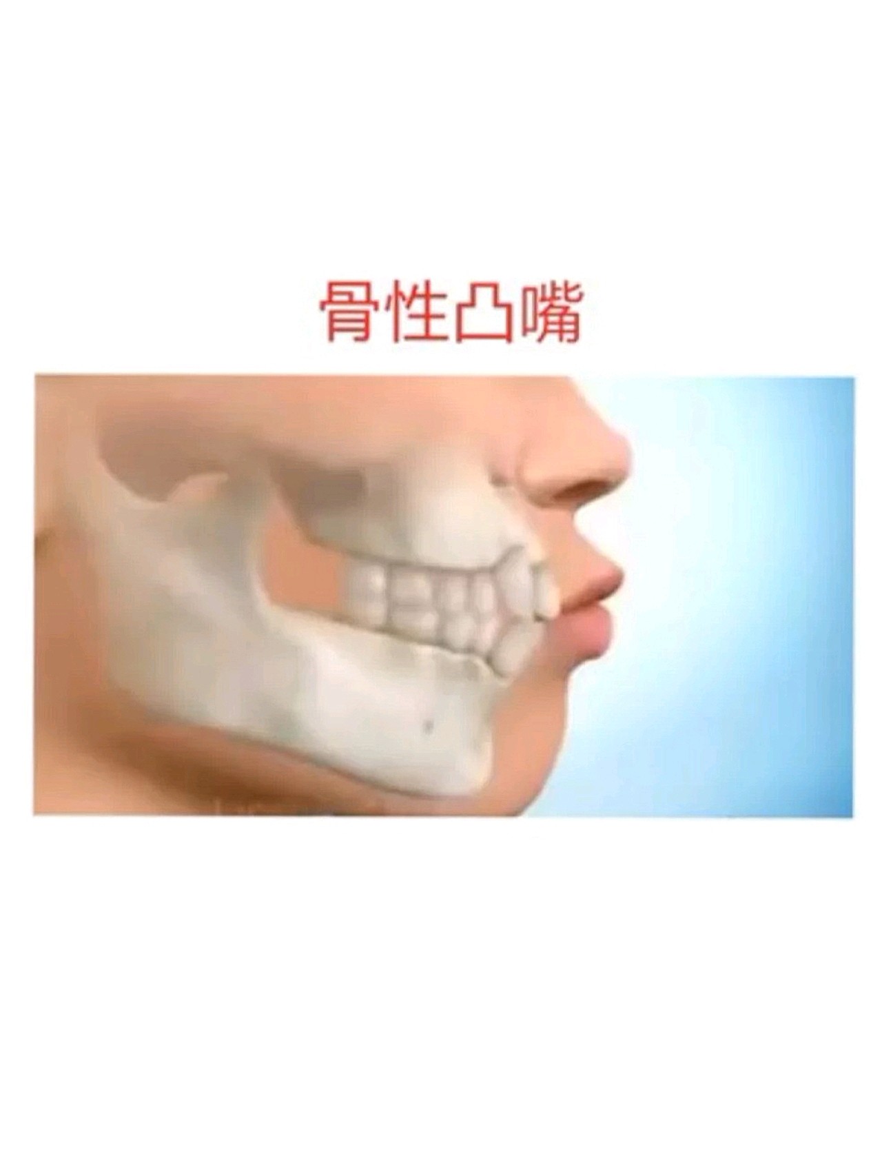 凸嘴分为两种:一种是牙性凸嘴,一种是骨性凸嘴.