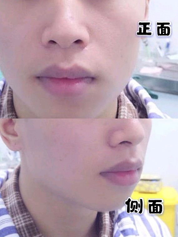【术前分析】 →正面观:上下唇偏厚,上唇唇线模糊且轻微不对称