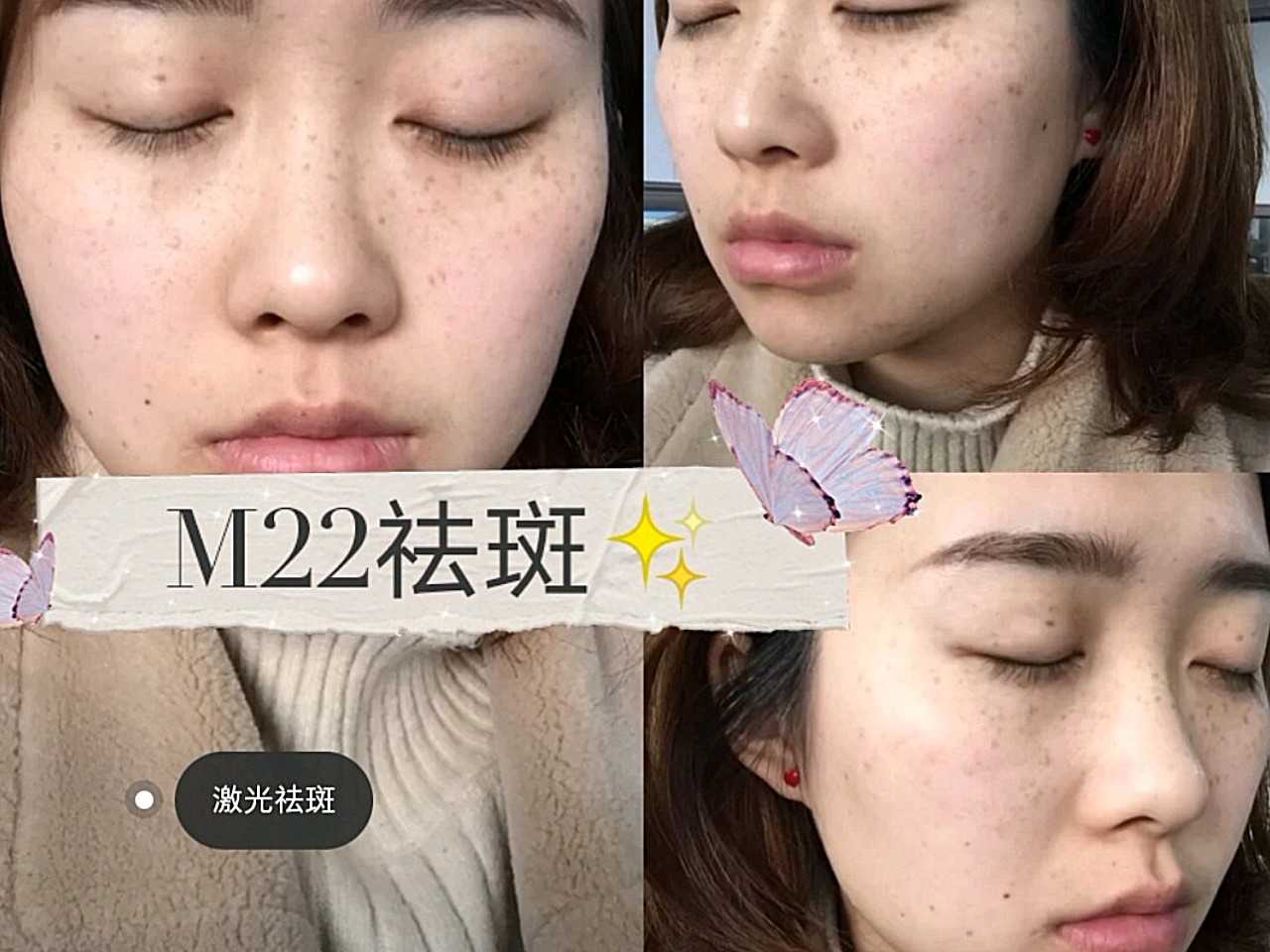 第一次激光祛斑的效果分享