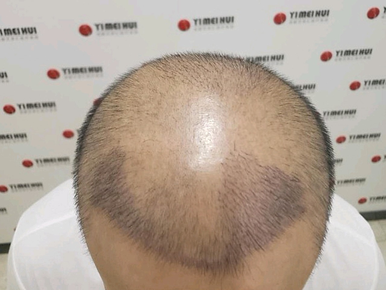 大哥在这边做完发际线移植有50天了9797头发进入