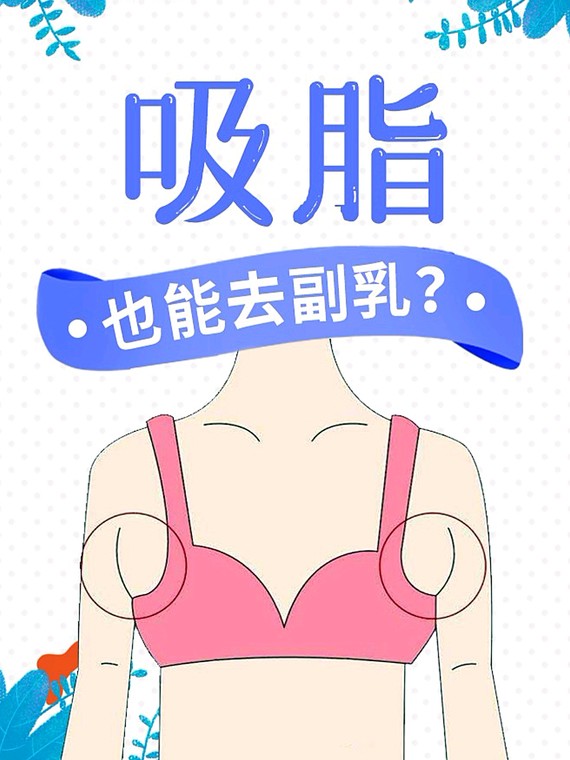 吸脂也能去副乳?
