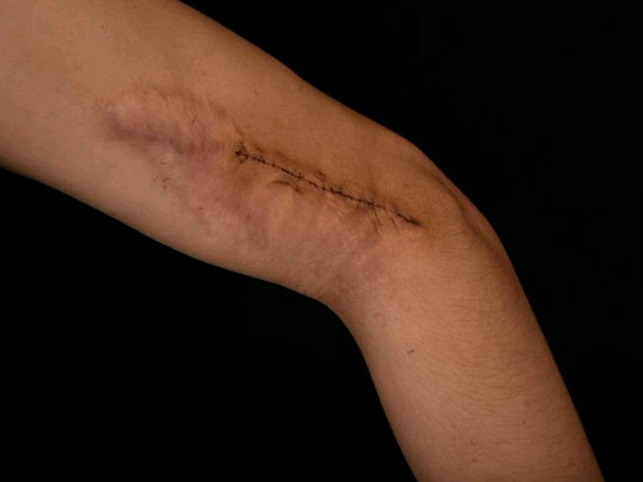 这是手臂缝针后留下的一道疤痕,挺难看的.夏天到了也