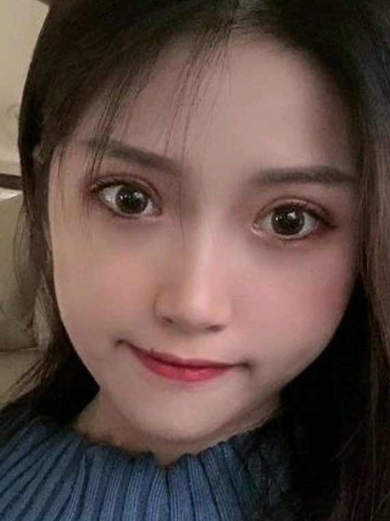 超超超自然的双眼皮#深圳双眼皮#不开刀双眼皮#韩式无痕双眼皮