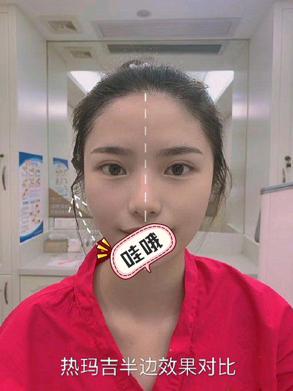 第五代热玛吉做完即刻效果简直惊呆了 !