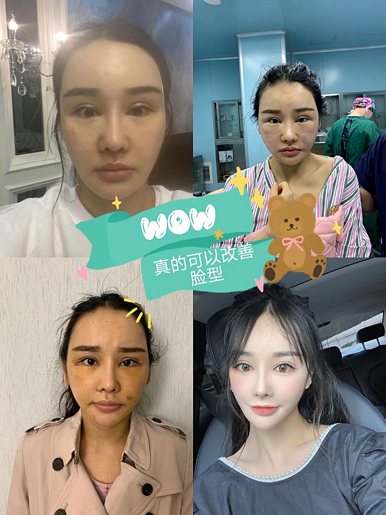 张晓建院长——小切口拉皮