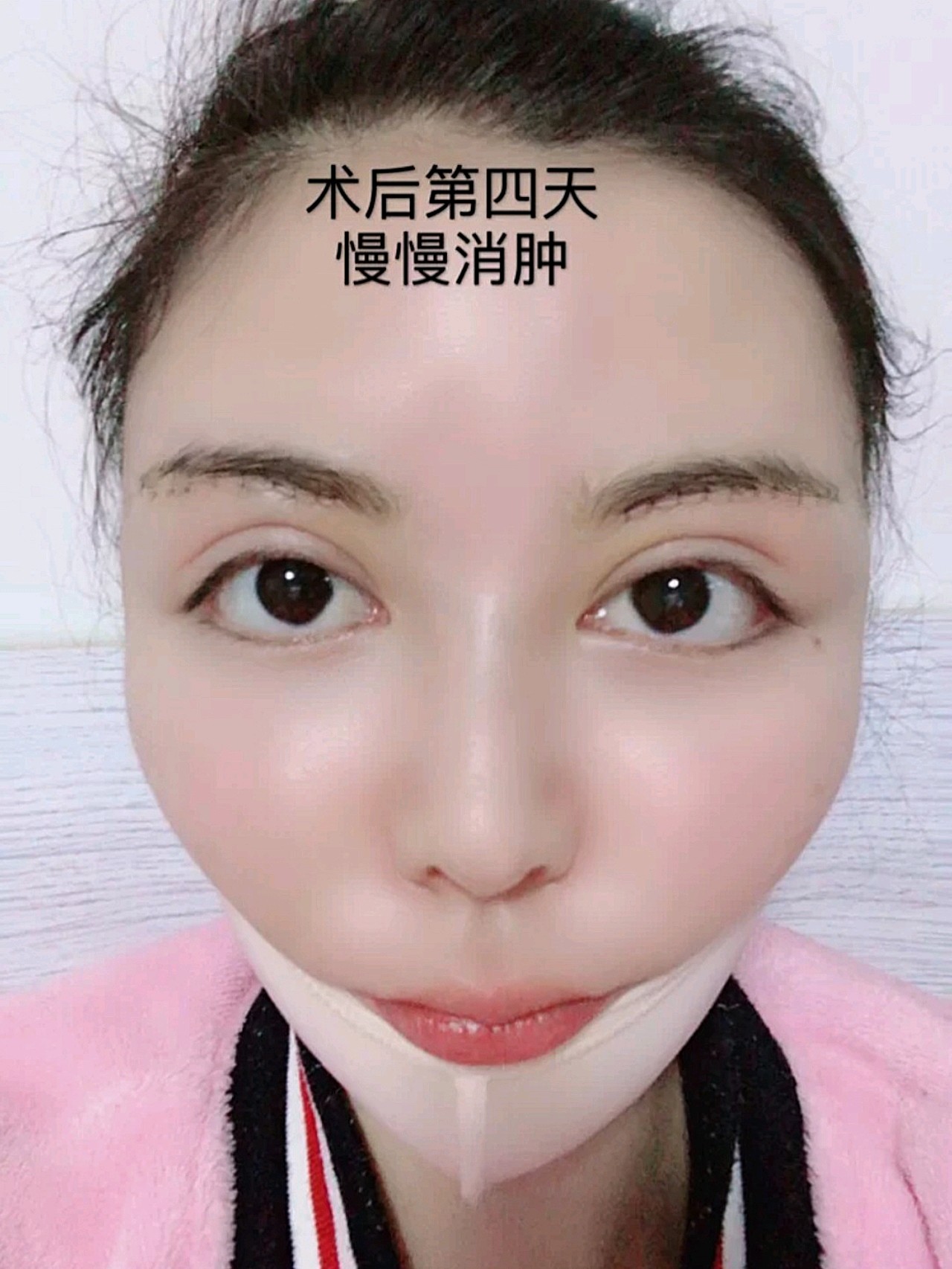 整容前后对,觉得还好吧.图:1整容前图2:初次整容_圈子-新氧美容整形