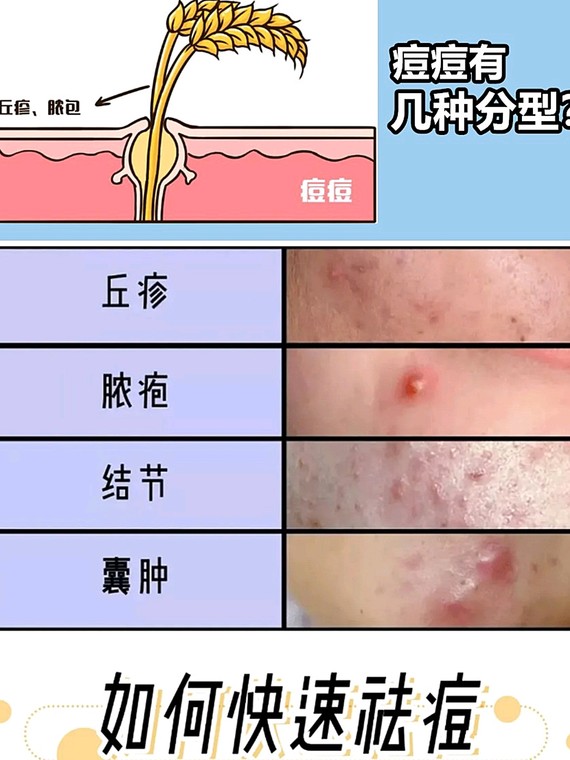 我们人的皮脂腺主要分布在面