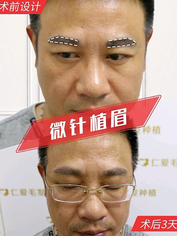 男士眉毛种植,有型有范!