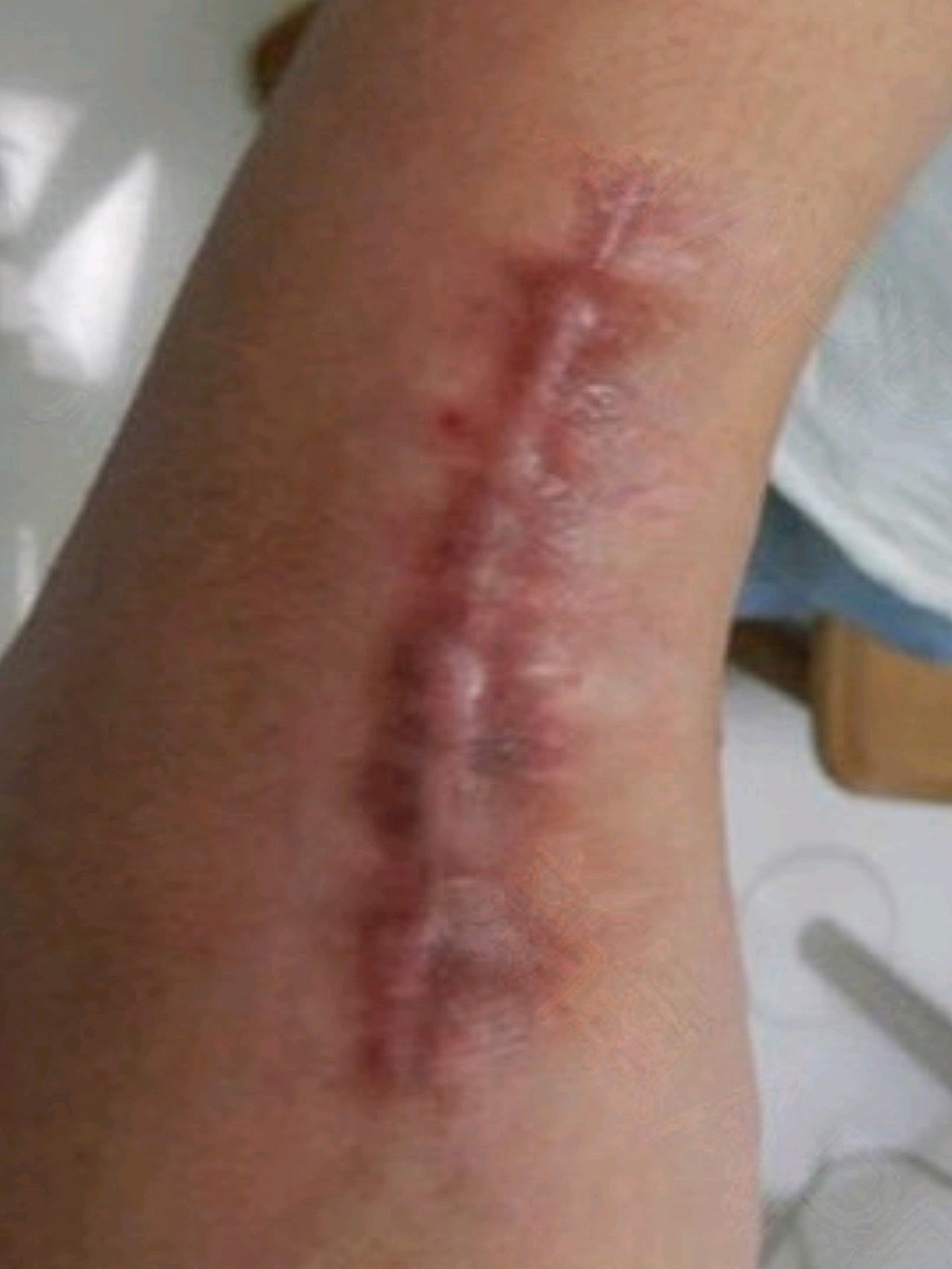 我的疤痕是之前动手术形成的,刚做完手术伤口又痒又痛,我以为是正常