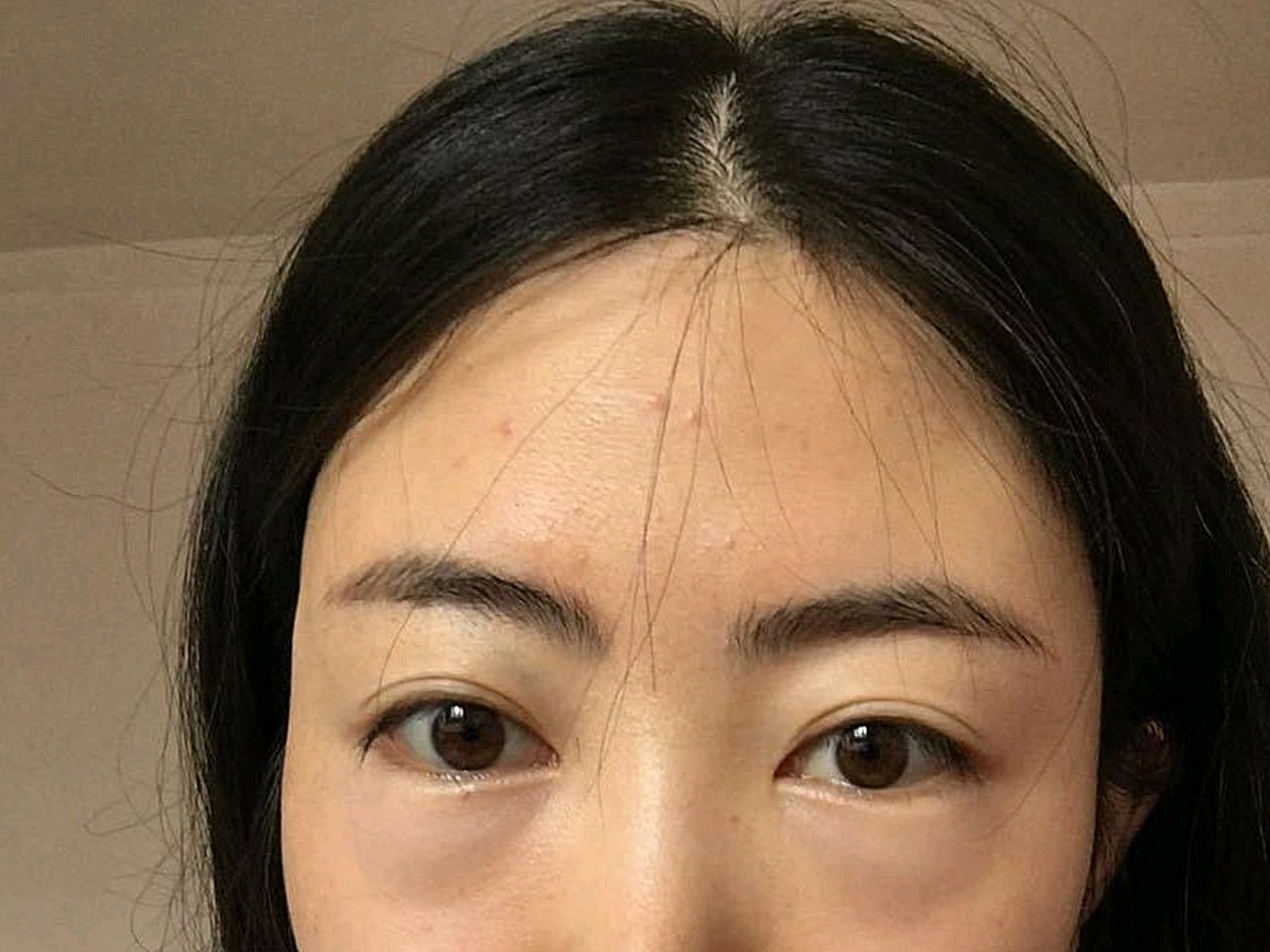 做了祛眼袋之后,我的卧蚕居然出来了