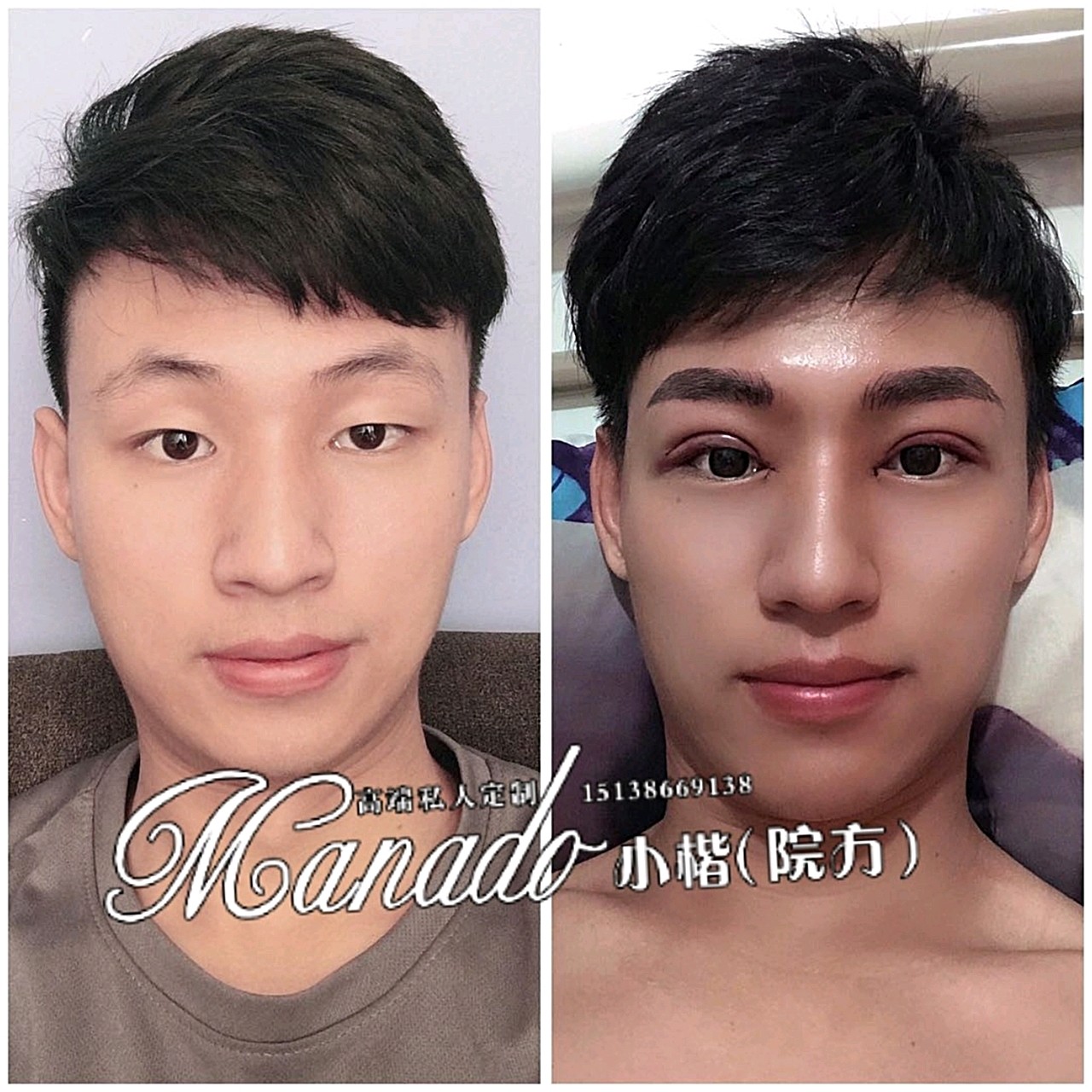 双眼皮男士术前术后对比图