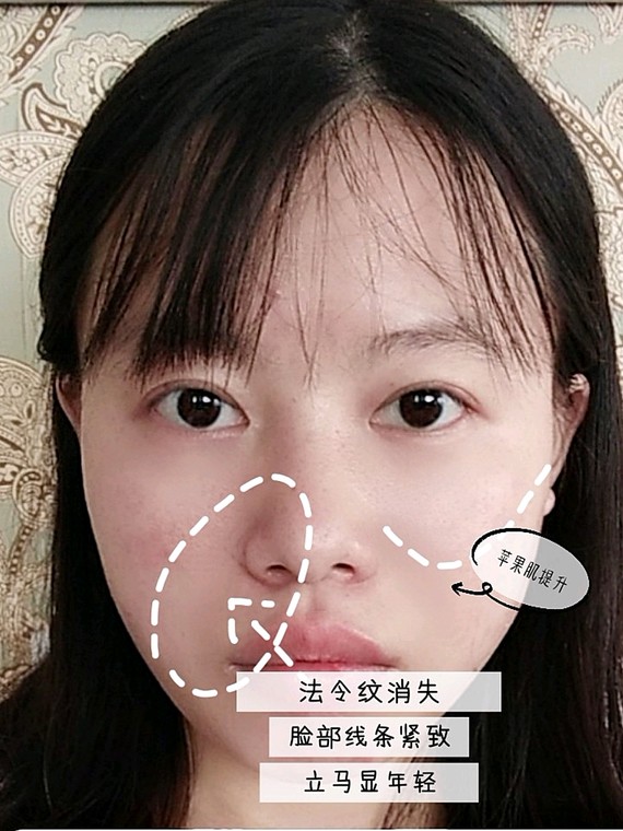 天生的法令纹,让我看着比实际年龄大好多,现在看着脸上的两条纹就很