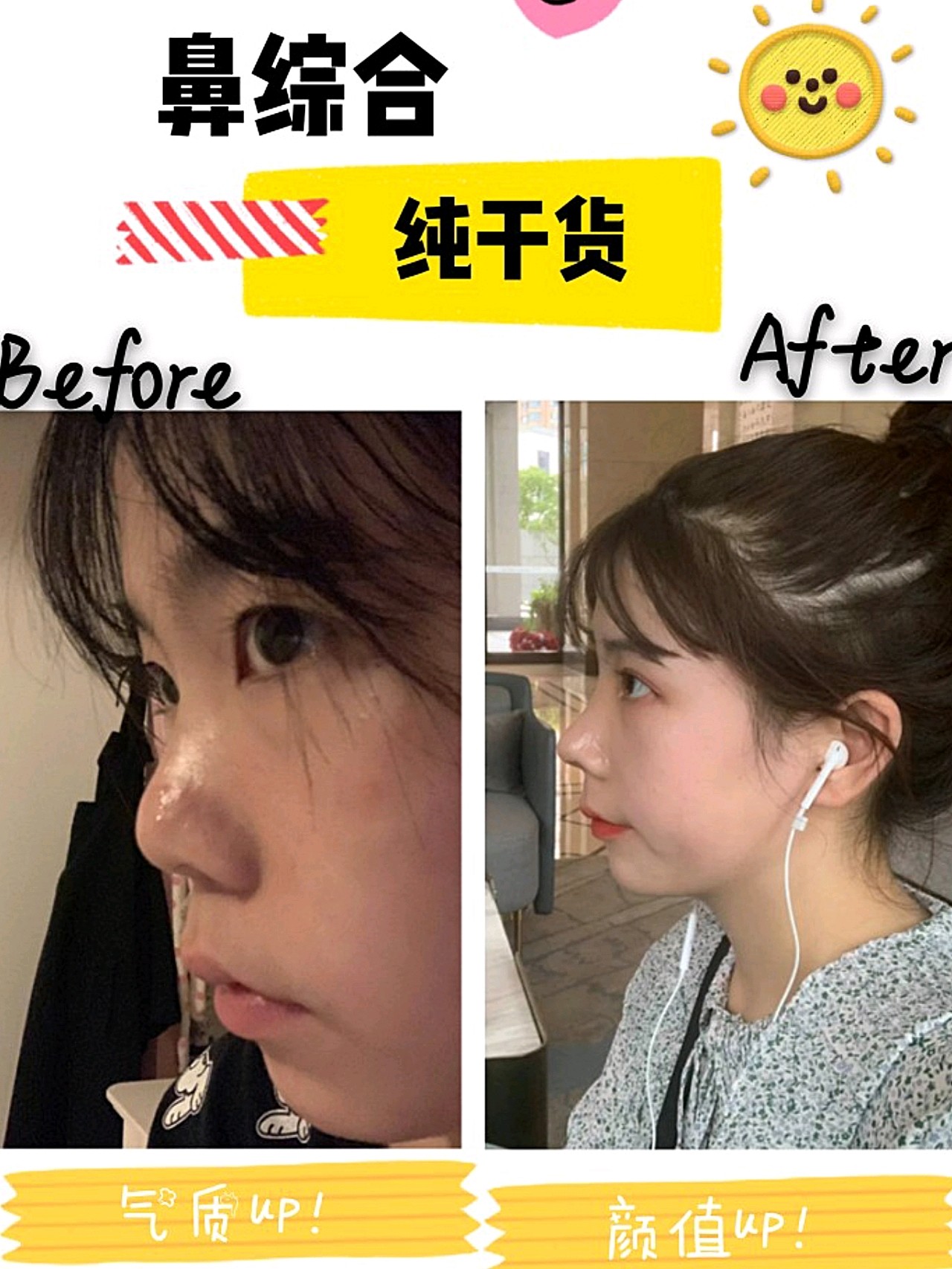 集美们～爱美丽的雨暮又来喽～鼻部多项真的可以瞬间提高我们的颜值