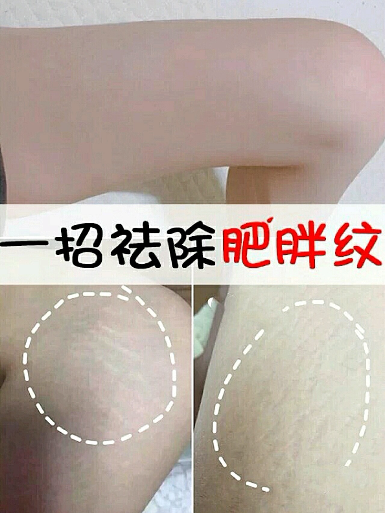 双侧大腿上臂内侧以及臀部外侧出现紫色或者白色的条纹,称为肥胖纹