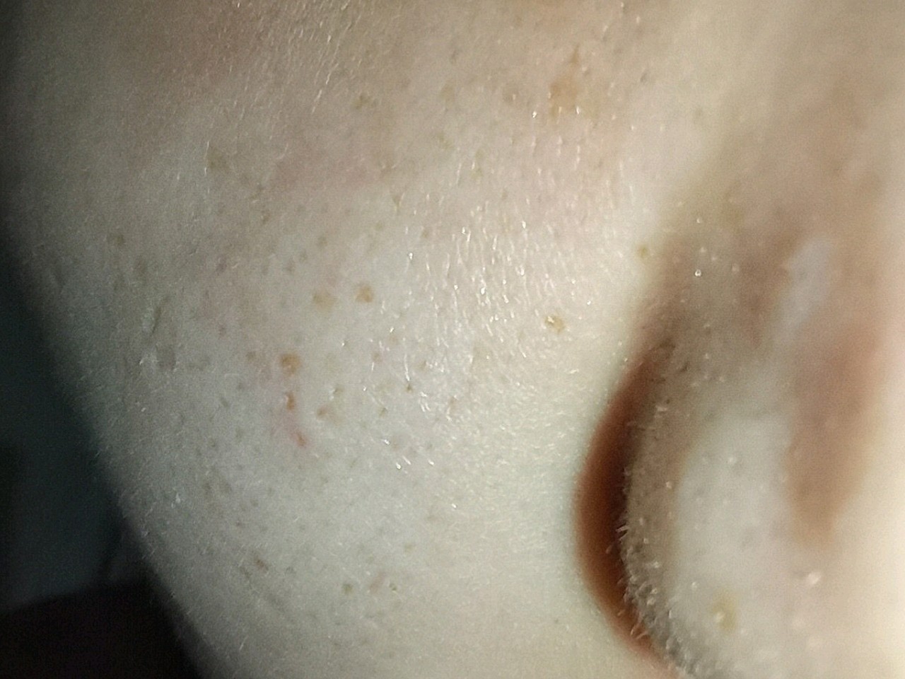 首先,我们要知道正常人的皮肤都是有毛孔的,如图2 接下来,如果我们的
