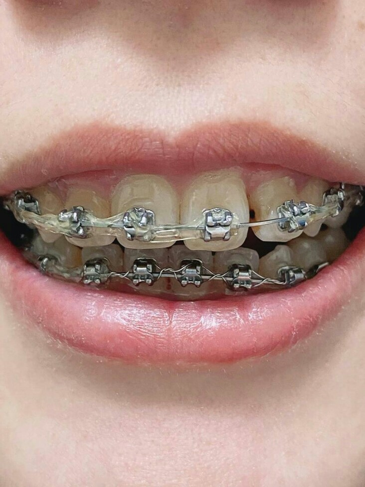 牙套材料选择:根据个人需求选择传统金属自锁,目标是两年内拆牙套.