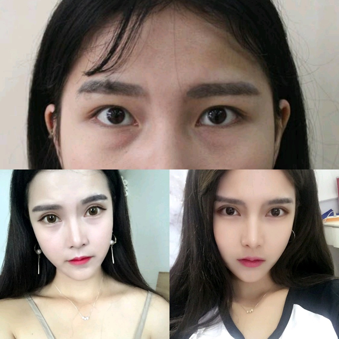 姑娘喜欢大眼睛,做了双眼皮 眶隔脂肪释放 开外眼角. 【方案