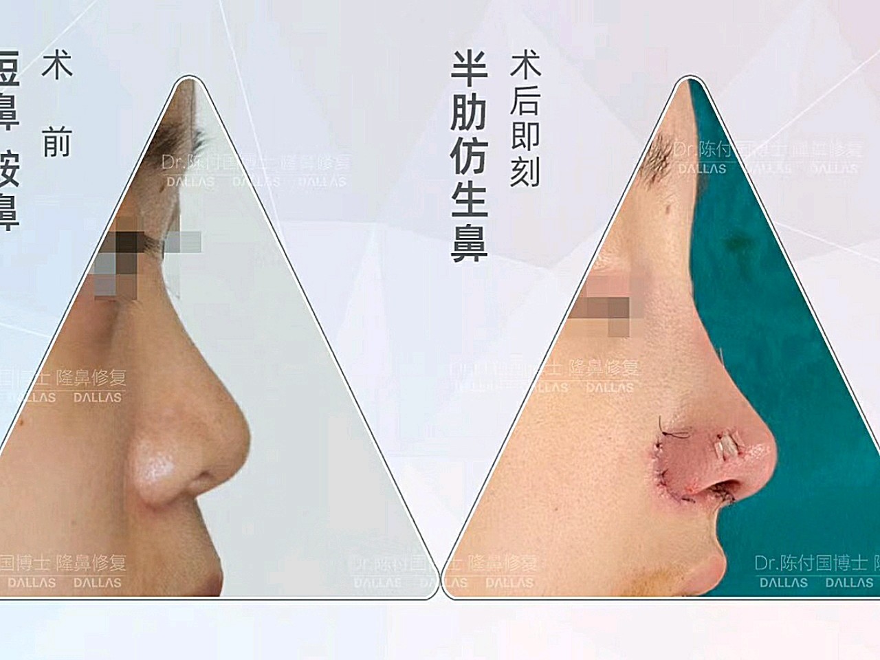 半肋仿生鼻术后即刻!