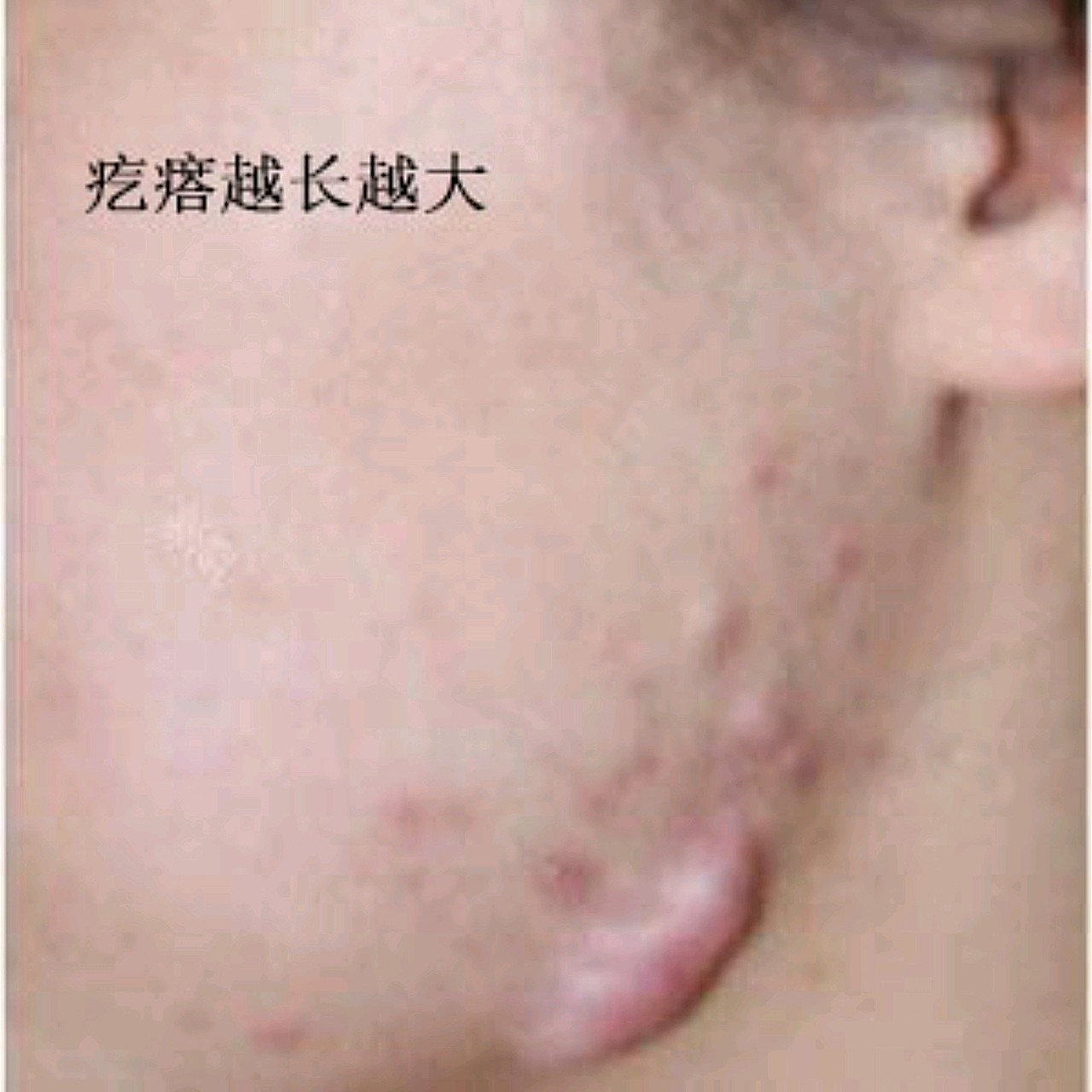 疤痕疙瘩有好几年,由于长期长痘痘,而且是疤痕体质,_圈子-新氧美容