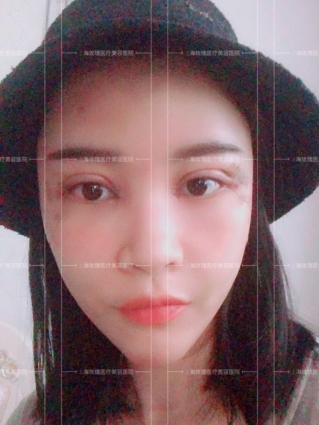 凹陷脸女孩的真实术后分享