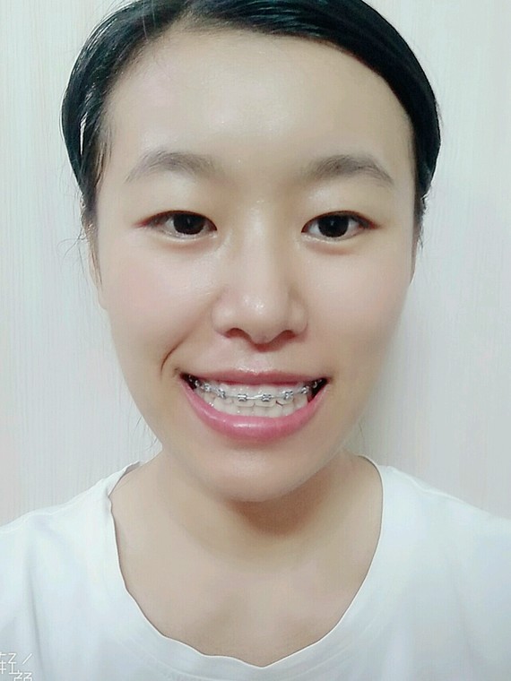 金属自锁矫正昨天来复诊了,医生给紧了下牙套上的钢丝_圈子-新氧美容