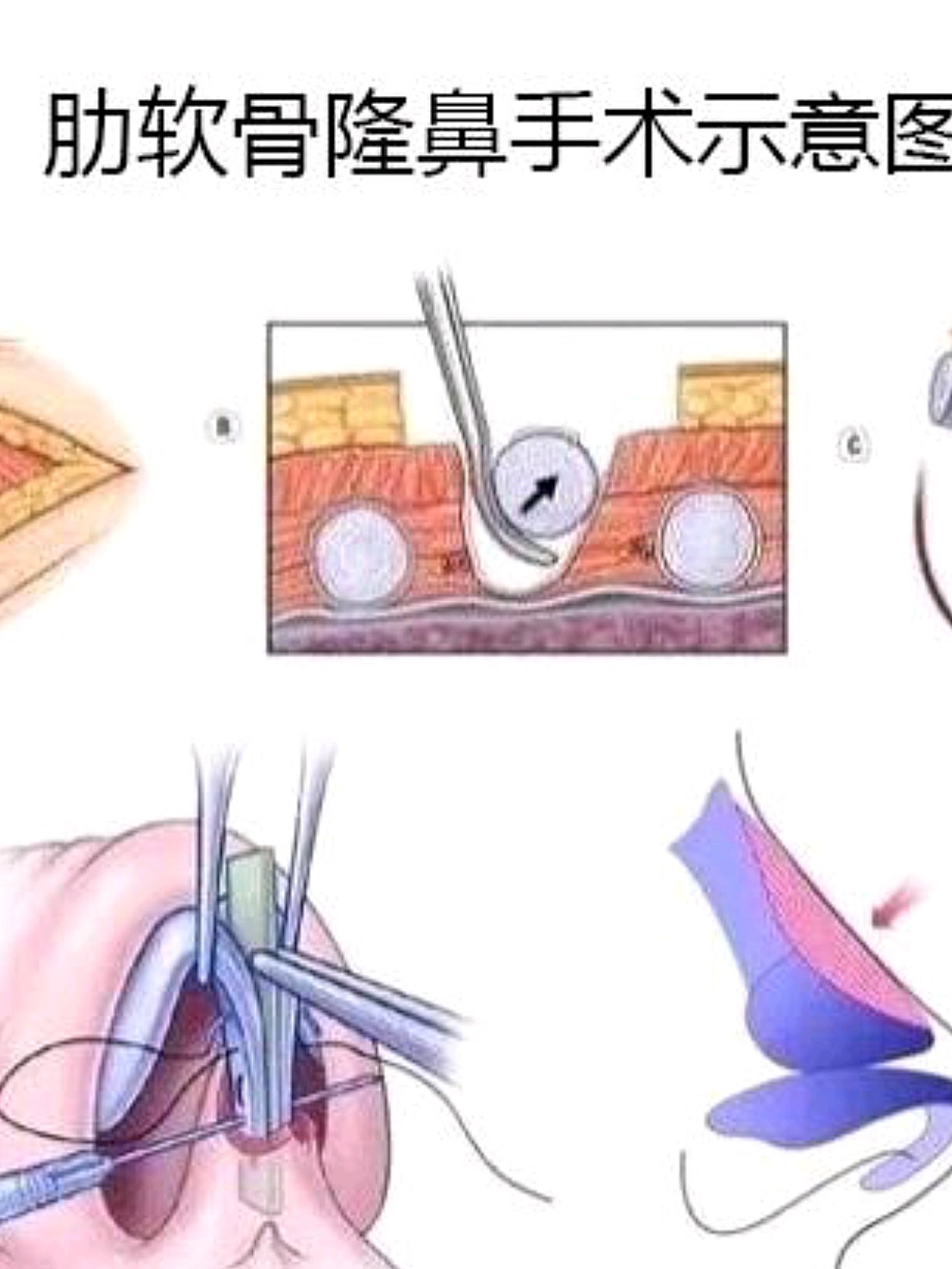 又高又翘的鼻子每个人都会心动呢,简直美的惊艳,自体肋软骨隆鼻帮助了