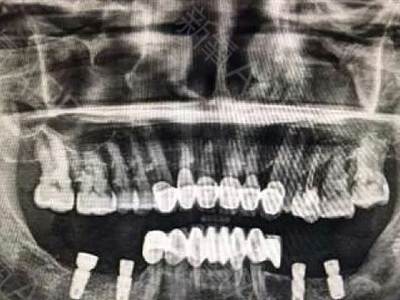 骨质评估种植牙基本流程 166术前准备 9696口腔全景片,颌骨ct