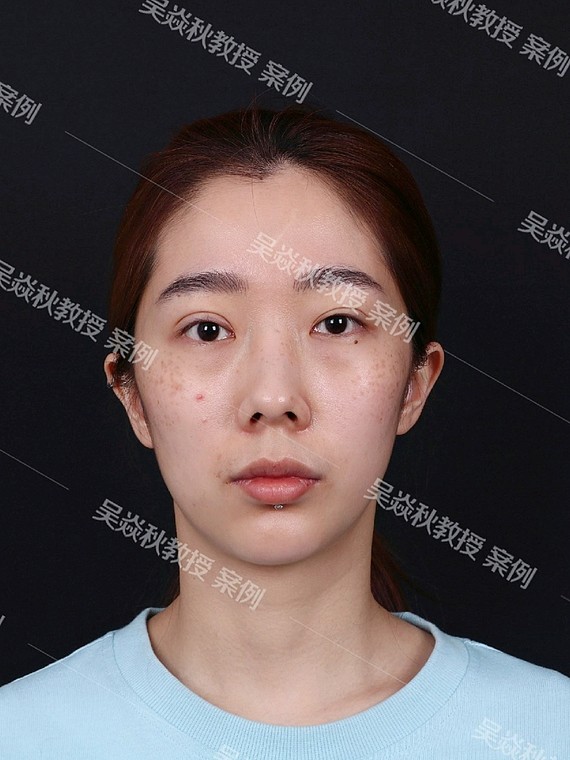 98所谓"欧式眼",表现为眼眶骨及眉骨与眼睑不在同一